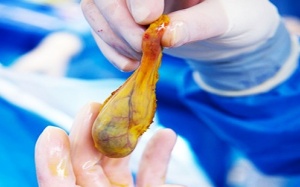 Ngoài phẫu thuật thì có cách nào điều trị sỏi túi mật không?