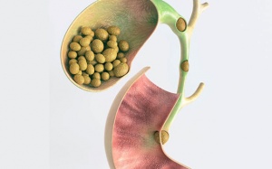 Sỏi mật thường không nguy hiểm, nhưng vẫn cần thận trọng đề phòng