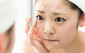 Bỏ túi 8 công thức trị mụn trứng cá từ nước vo gạo