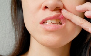 Mách bạn cách chữa bệnh nhiệt miệng tại nhà đơn giản