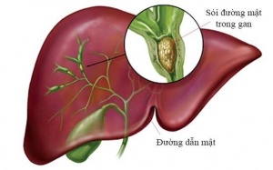 Sỏi đường mật trong gan có thể gây biến chứng nguy hiểm gì?