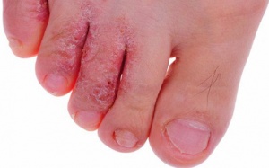 Trị bệnh nấm da chân như thế nào?