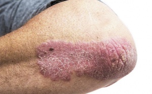 Những điều cần biết về bệnh vảy nến thể mảng