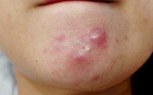 Thoát khỏi mụn nang đơn giản bằng 5 nguyên liệu tự nhiên 