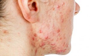 Mách bạn cách xử trí mụn nang tại nhà đơn giản