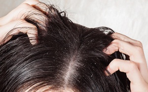 Giải pháp nào cho mái tóc bết dầu?