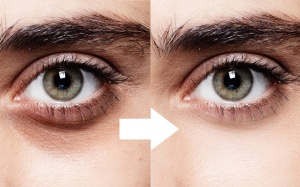 Quầng thâm mắt: Nguyên nhân và cách khắc phục? 