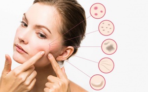 Azelaic acid: giải pháp trị mụn trứng cá