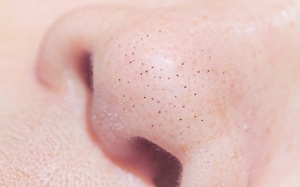 Trị mụn đầu đen tại nhà không khó 