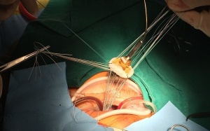 Bị hở van 2 lá nên thay van cơ học hay van sinh học?