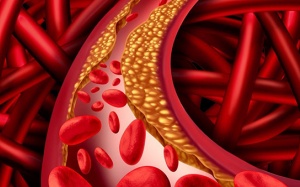 Máu nhiễm mỡ có nguy hiểm không?