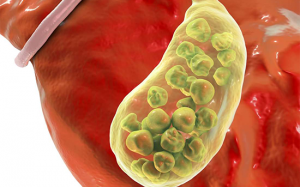 Đã cắt túi mật nhưng sỏi mật vẫn tái phát, phải làm sao?