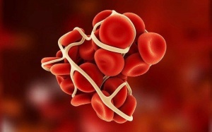 Tại sao cục máu đông có thể gây tai biến mạch máu não?
