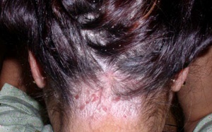 5 nguyên liệu tự nhiên giúp trị vẩy nến da đầu ngay tại nhà