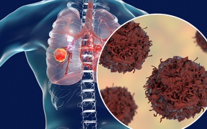 Gia đình có tiền sử ung thư: Làm thế nào để phòng ngừa ung thư phổi?