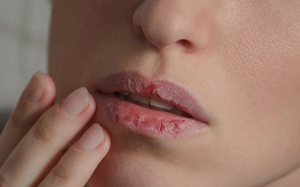 “Cấp cứu” đôi môi khô, nứt nẻ vào thời điểm giao mùa