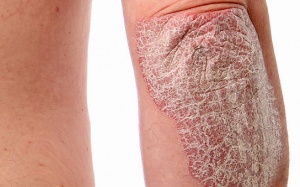 Những thực phẩm người bị vảy nến cần tránh