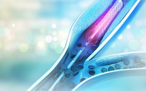 Bị nhồi máu cơ tim, đặt stent 1 tháng vẫn mệt có sao không?