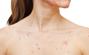 Bí quyết trị mụn trứng cá ở ngực đơn giản tại nhà