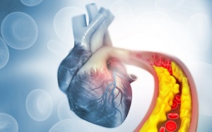 Hở van 2 lá 3/4, mỡ máu cao đã phải thay van chưa?