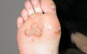 Cách trị mụn cóc đơn giản tại nhà