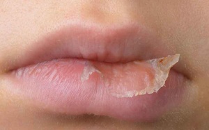 Mẹo hay tạm biệt làn môi nứt nẻ, bong tróc