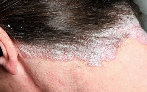 Bật mí cách xử trí bệnh vảy nến da đầu tại nhà