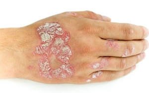 Phải làm sao để kiểm soát bệnh vảy nến thể mảng?