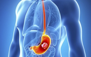 Những ai có nguy cơ cao mắc ung thư dạ dày?