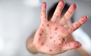 Trẻ bị tay chân miệng nên xử lý như thế nào?