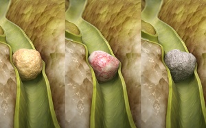 Làm thế nào để xác định chính xác thành phần của sỏi mật?