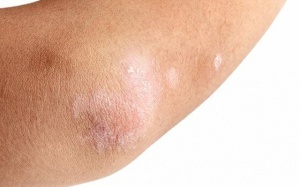Da khô, sần sùi ở khuỷu tay và cách xử lý dễ dàng