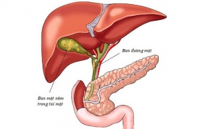 Điều trị sỏi bùn túi mật bằng thuốc gì?