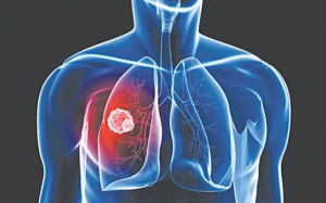 Kéo dài tuổi thọ cho người bị ung thư phổi giai đoạn cuối