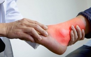 4 cách cải thiện bệnh gout ở mắt cá chân an toàn, hiệu quả