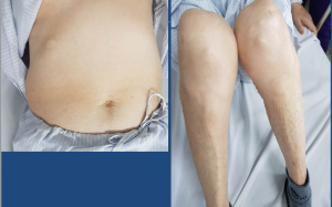 Cảnh báo: Teo cơ tứ chi, suy tuyến thượng thận do lạm dụng corticoid