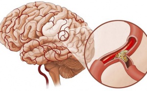 Giúp người bị tai biến mạch máu não nhanh hồi phục bằng cách nào?