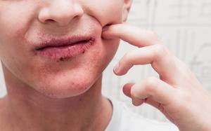 Cách kiểm soát bệnh vảy nến da mặt hiệu quả