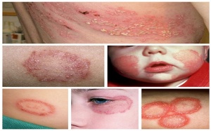 “Bỏ túi” cách xử trí bệnh hắc lào tại nhà nhanh chóng