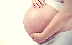 Mách mẹ bầu cách ngăn rạn da khi mang thai