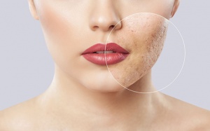 Bí kíp xóa mờ sẹo mụn trứng cá “lợi hại” chị em nên biết