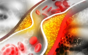 Tăng huyết áp kèm mỡ máu cao điều trị thế nào?