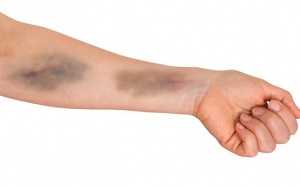 Xuất hiện vết bầm tím trên da có nguy hiểm không?