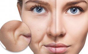 Cách làm đầy rãnh cười đơn giản không cần phẫu thuật
