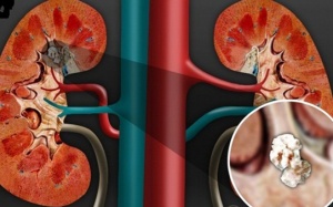 Những loại thực phẩm có thể “quật ngã” thận mà bạn nên tránh xa