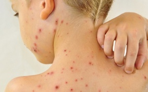 Làm thế nào để giảm ngứa khi bị thủy đậu?