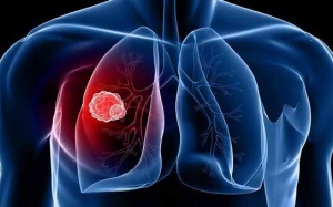 Bệnh u phổi có chữa được không?