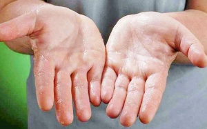 Tạm biệt mồ hôi tay bằng biện pháp tự nhiên đơn giản