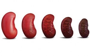 Cần làm gì để ngăn ngừa suy thận trở nên nặng hơn?