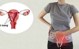 Biến chứng nguy hiểm do u xơ tử cung